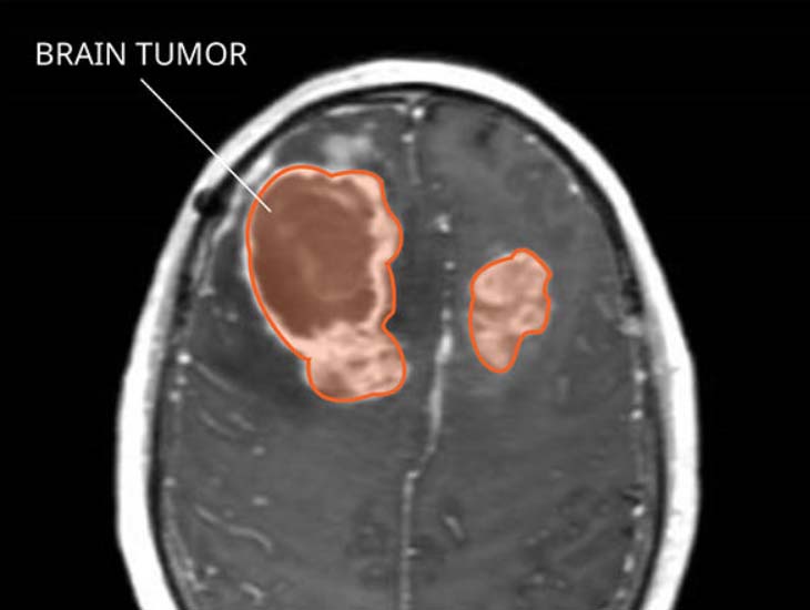 تصوير اورام المخ بالرنين المغناطيسي MRI