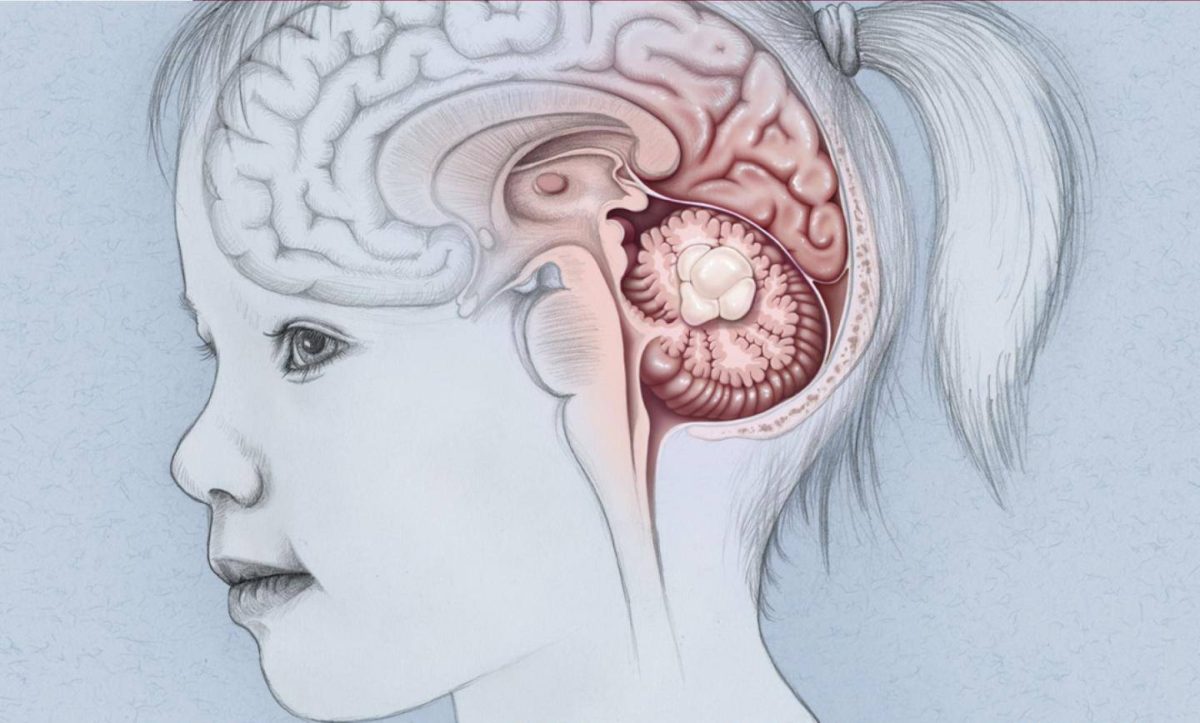 تعتبر أورام الدماغ أحد أسباب بروز في عظمة الجمجمة من الخلف عند الأطفال