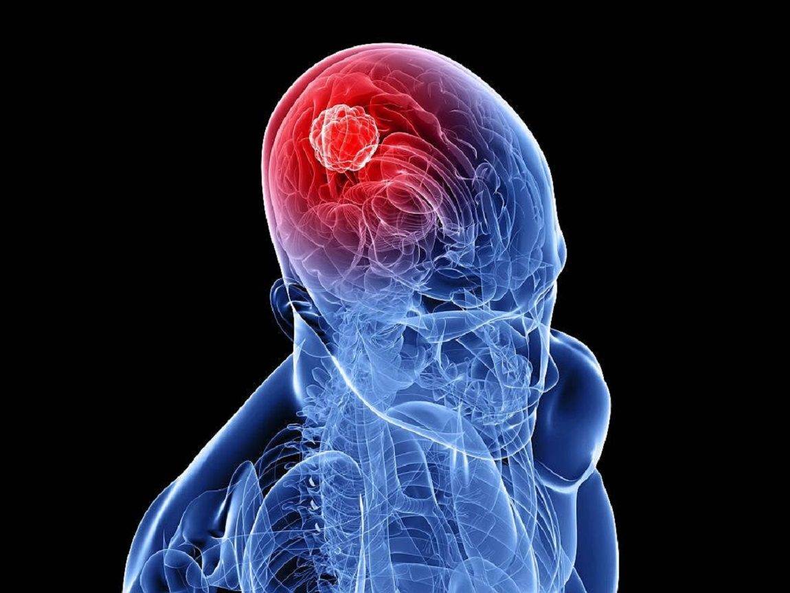 الورم البطاني العصبي أحد أنواع الأورام الخبيثة في المخ 