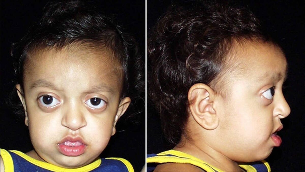 متلازمة كروزون هذه هي المتلازمة الأكثر شيوعًا المرتبطة بتعظم الدروز الباكر وهو يسبب بروز في عظمة الجمجمة من الأمام عند الطفل وتشوهات منتصف الوجه