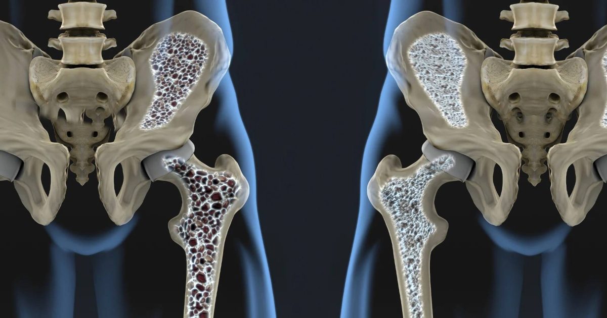 الأدوية التي يتم تناولها لإدارة نوبات الصرع يمكن أن تضعف العظام ويمكن أن يؤدي فقدان العظام إلى هشاشة العظام