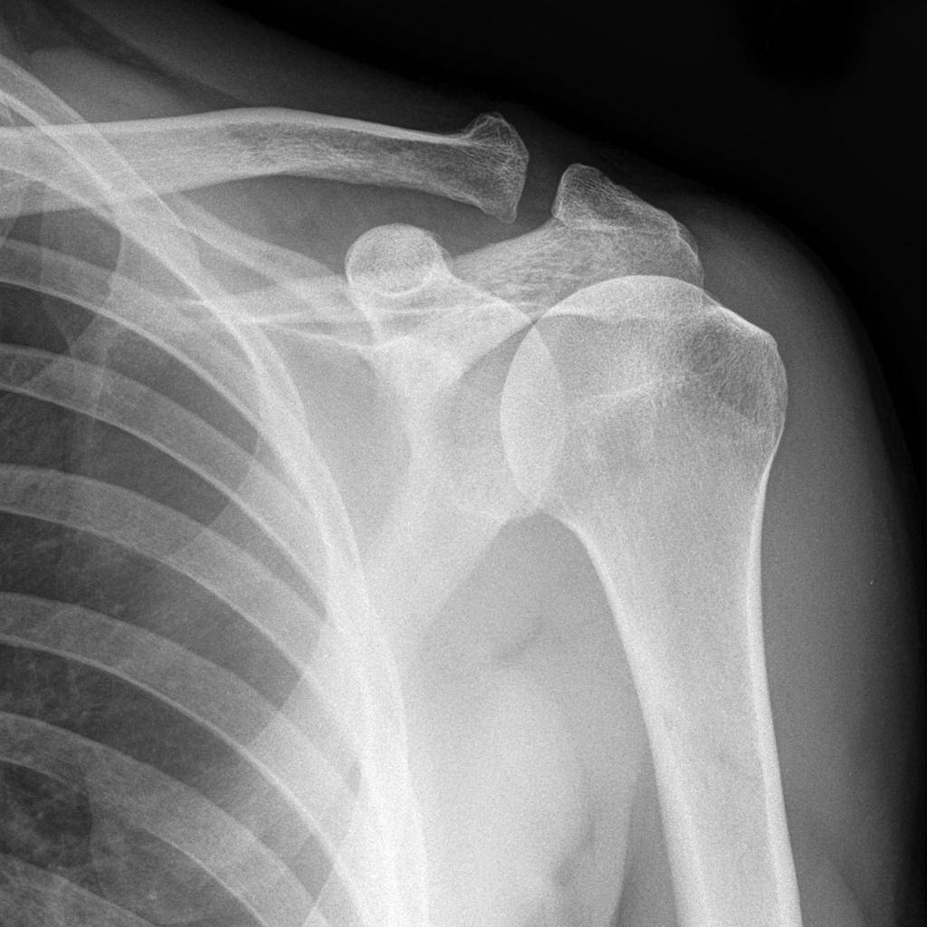 يتم إجراء الأشعة السينية على منطقة الكتف، والرقبة، للكشف عن  إصابة المريض بكسور أو أي إصابات أخرى مرتبطة بتلك المنطقة.