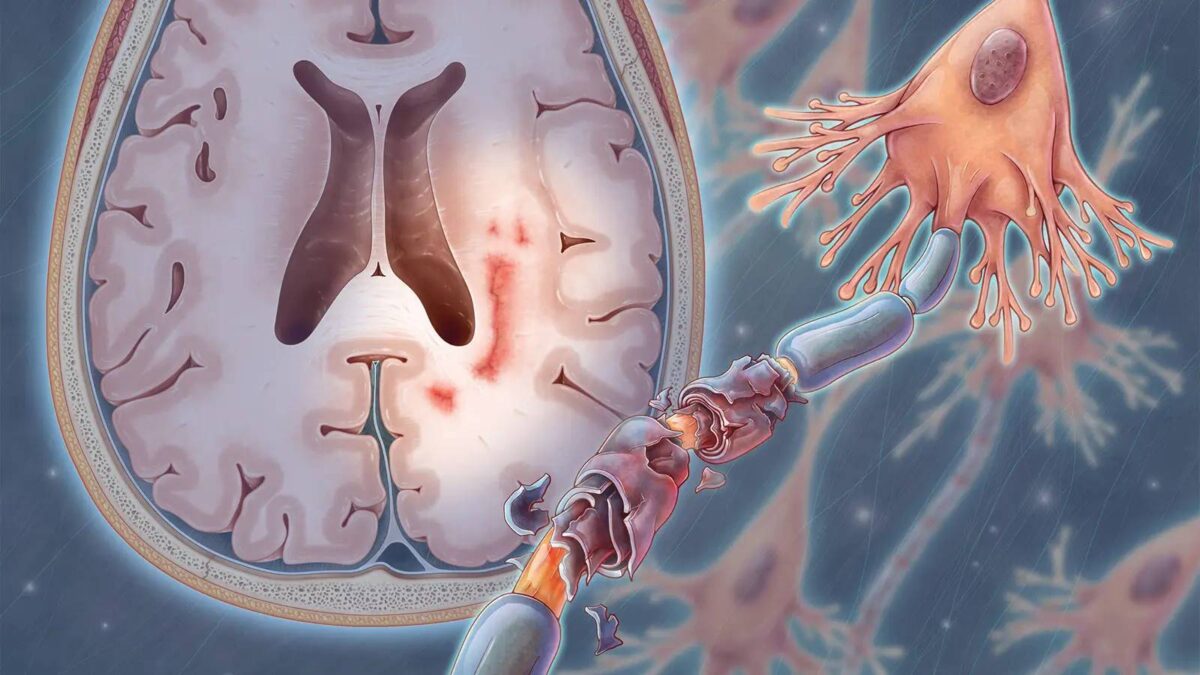 من المرجح أن تصاب النساء في البداية بمرض التصلب العصبي المتعدد الناكس (RRMS) وهو النوع الأكثر شيوعًا من مرض التصلب العصبي المتعدد